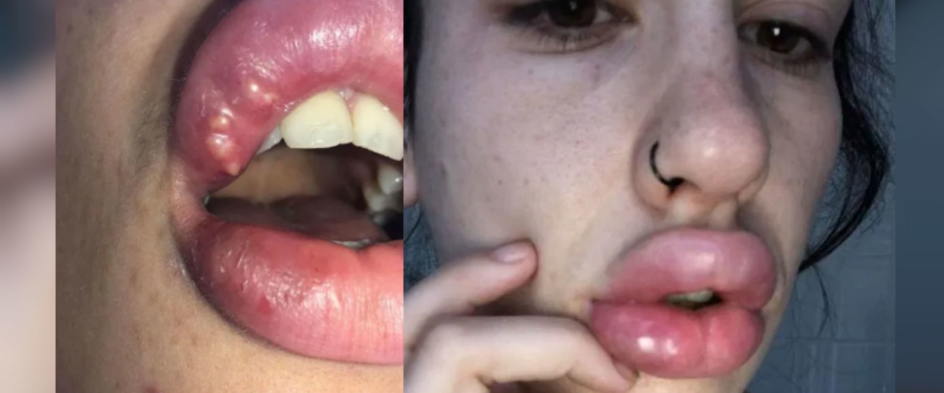 La importancia del descanso y la recuperación después del tratamiento labial con ácido hialurónico