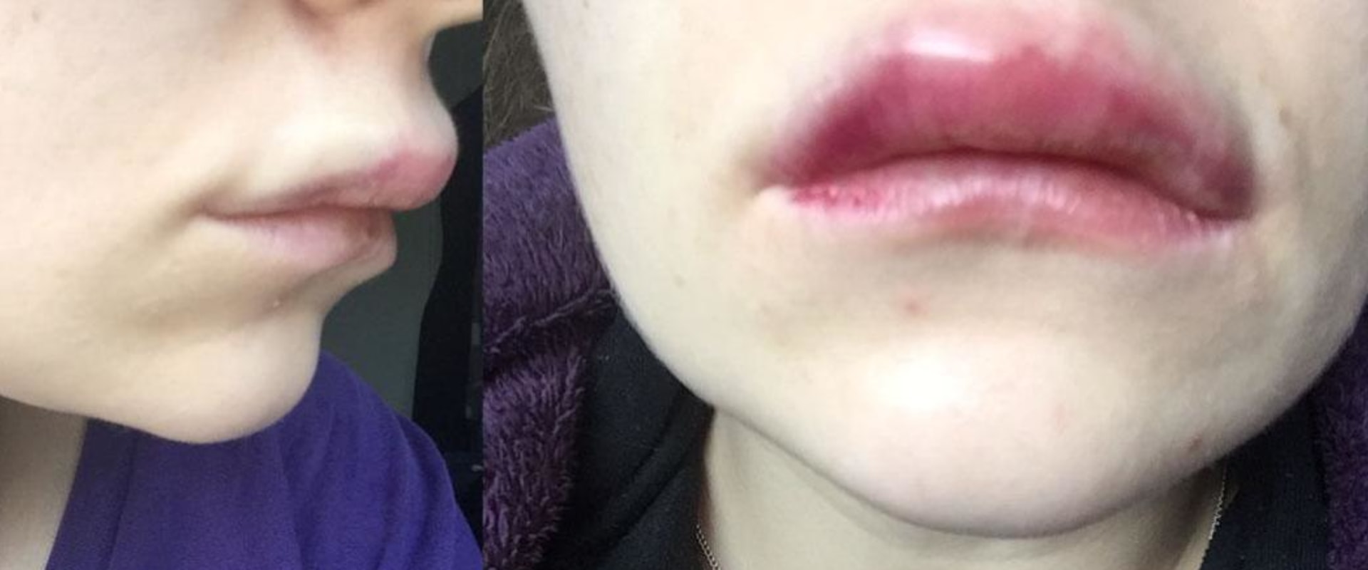 Cuánto dura la inflamación después de aumento de labios?
