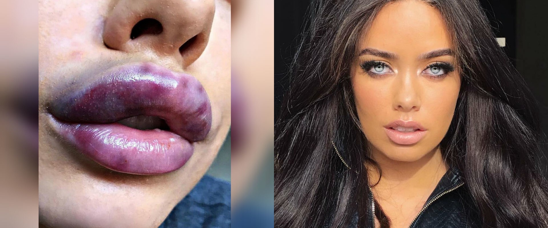 Cómo puedo saber si me quedará bien el relleno de labios?