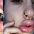 Cuándo puedo pintar los labios después de ácido hialurónico?