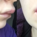 Cómo bajar inflamación labios ácido hialurónico?