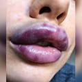 Cómo puedo saber si me quedará bien el relleno de labios?