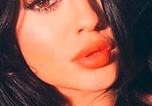 Cuánto tarda en desinflamar el relleno de labios con ácido hialurónico?