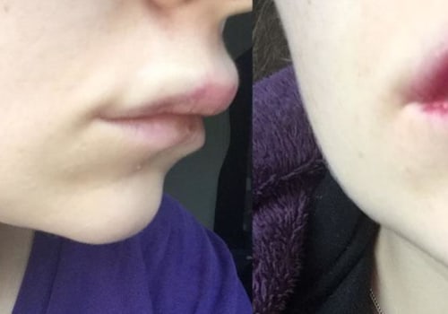 Que no hacer cuando te pones ácido hialurónico en los labios?